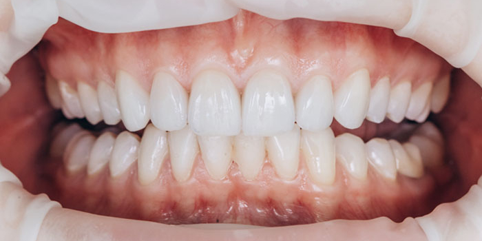 5 Consejos para cuidar tus carillas dentales