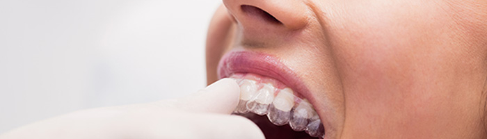 Retenedores dentales: cómo hacer que duren mas.