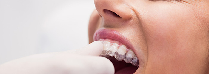 Retenedores dentales: cómo hacer que duren mas.