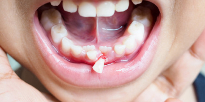 ¿Qué hacer ante un traumatismo dental en tus hijos?
